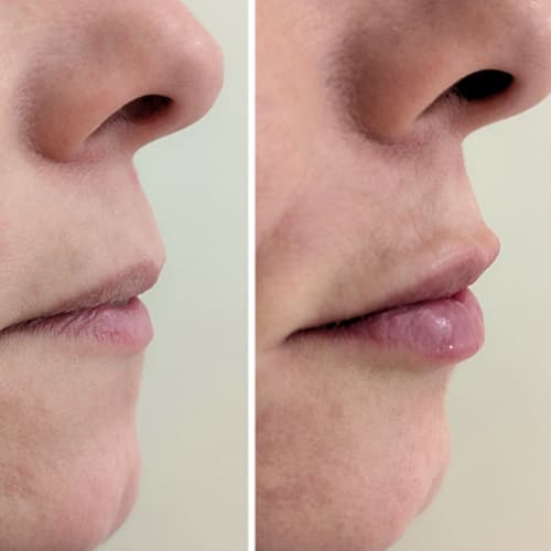 acido labios clinica estetica badajoz | Biomedical Dental & aesthethic | Mejores clinicas de Badajoz