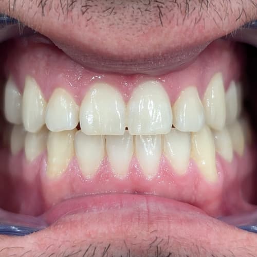 tratamiento ortodoncia invisible resultados clinica biomedical dental badajoz