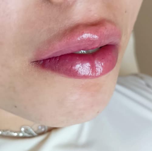 tratamiento con acido hialuronico - home- galeria 3