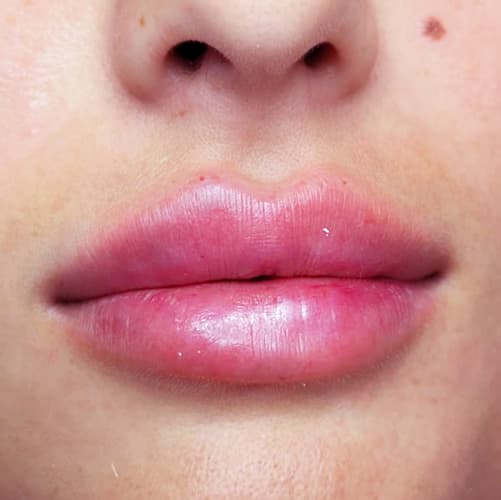 Labios con hialuronico e hidratación - Biomedical Dental Aesthethic Badajoz