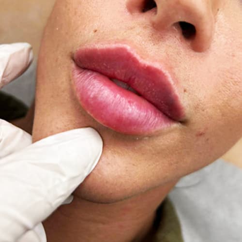 galeria home | volumen de labios en badajoz | Biomedical Dental & Aesthetic