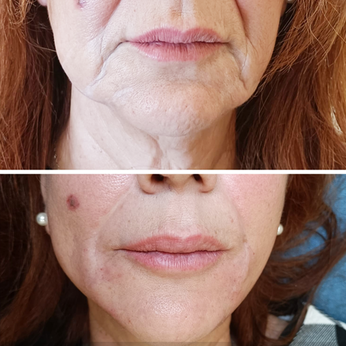 rejuvenecimiento-home-biomedicaldental-antesydespues