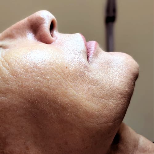 Rejuvenecimiento facial en Biomedical Dental Badajoz | Consúltanos tu caso